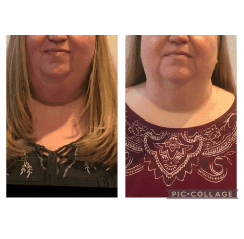 Double Chin Slimming In Charlottesville, VA By Health & Wellness Spa