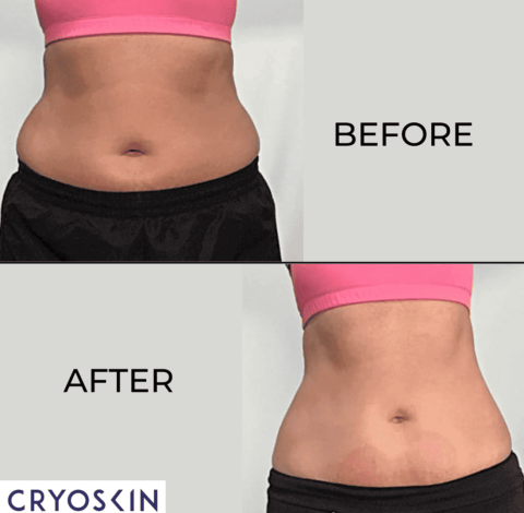 Before and After Images Of Slimming Treatment By Charlottesville, VA In Health & Wellness Spa