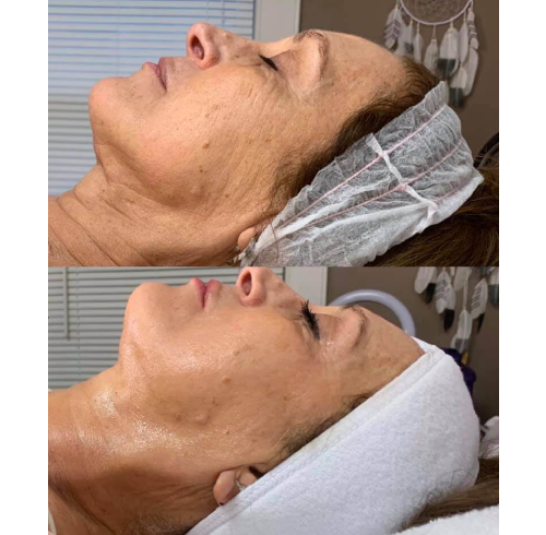 Facial Treatments In Charlottesville, VA By Health & Wellness Spa