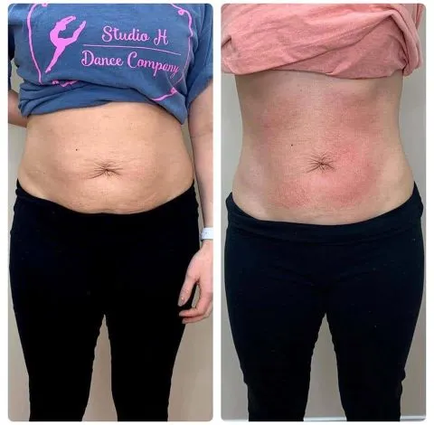 CryoSkin 20 Before and after abdominal slimming in Charlottesville, VA