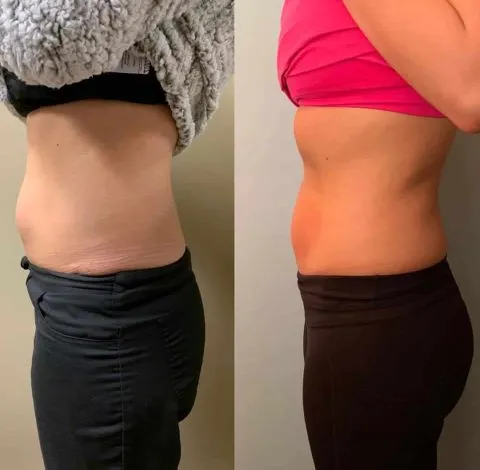 CryoSkin 21 Before and after abdomen slimming in Charlottesville, VA