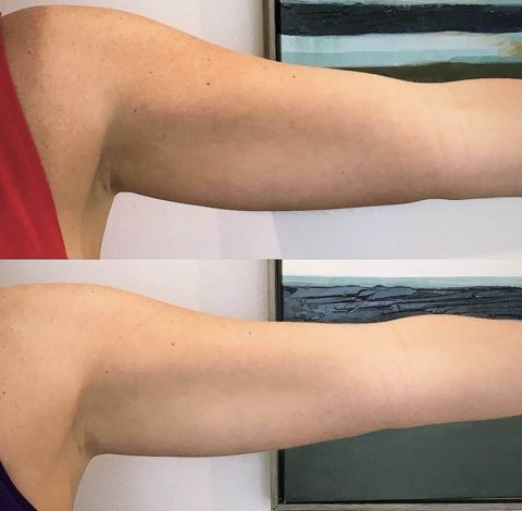 Before & After Image Of Slimming Treatment In Charlottesville, VA | Health & Wellness Spa