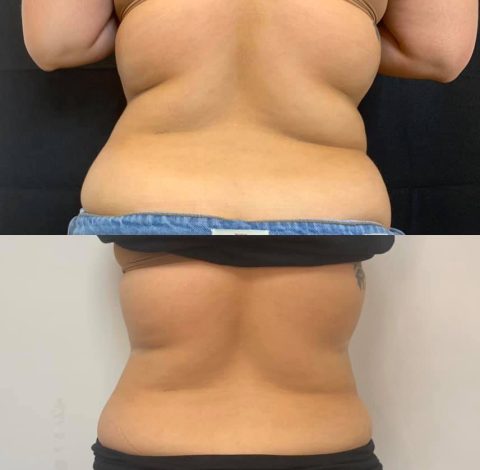 Slimming Treatment In Charlottesville, VA By Health & Wellness Spa