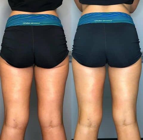 Before & After Image Of Slimming Treatment In Charlottesville, VA | Health & Wellness Spa