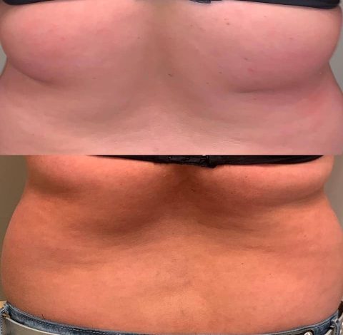 Before & After Image Of Slimming Treatment In Charlottesville, VA | Health & Wellness Spa