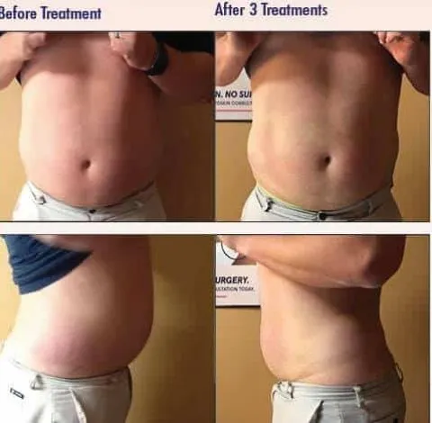 CryoSkin 18 Before and after abdominal slimming treatment at Health and Wellness Spa
