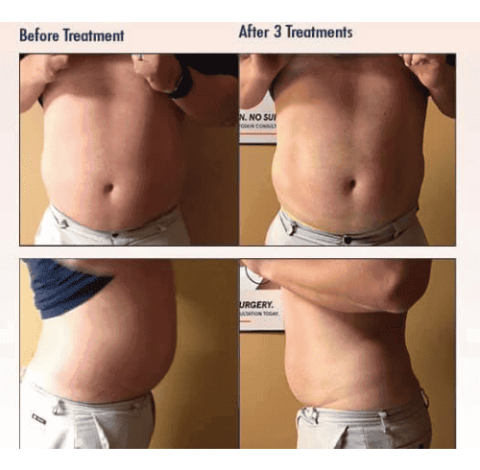 Slimming Treatment By Charlottesville, VA In Health & Wellness Spa