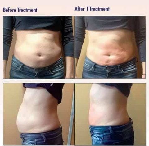 Before & After Image Of Slimming Treatment In Charlottesville, VA | Health & Wellness Spa