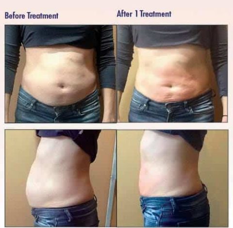 Before and after slimming treatment in Charlottesville, VA, at Health & Wellness Spa