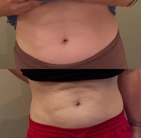 CryoSkin 24 Before & After Image Of Slimming Treatment In Charlottesville, VA | Health & Wellness Spa