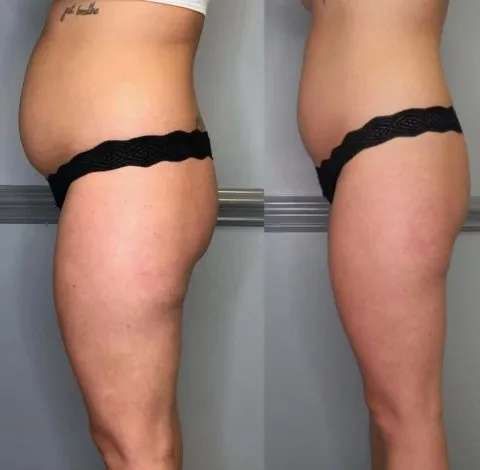 CryoSkin 16 Before and after abdominal slimming treatment showing reduced belly fat