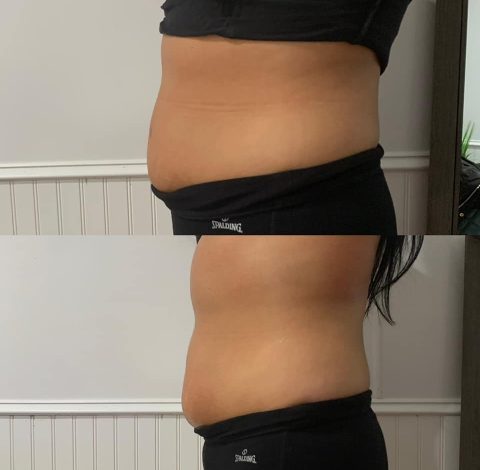 Before & After Image Of Slimming Treatment In Charlottesville, VA | Health & Wellness Spa