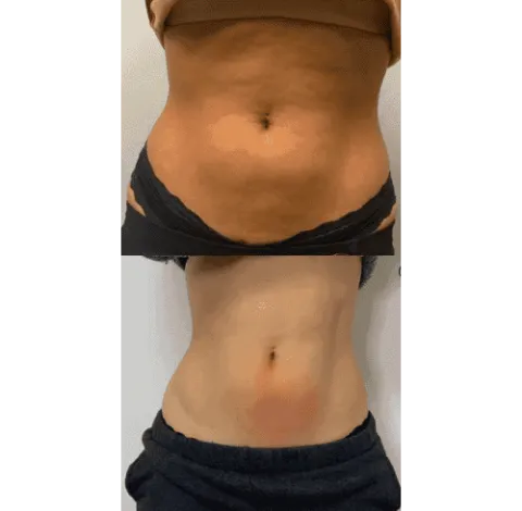 CryoSkin 28 Slimming Treatment Charlottesville, VA In Health & Wellness Spa