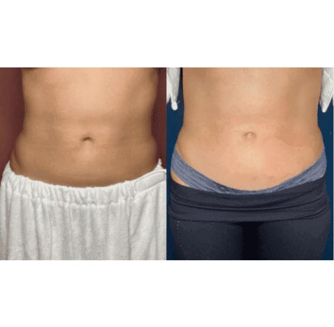 Slimming Treatment By Charlottesville, VA In Health & Wellness Spa