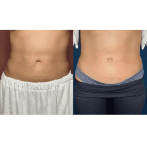 CryoSkin 27 Slimming Treatment Charlottesville, VA in Health & Wellness Spa