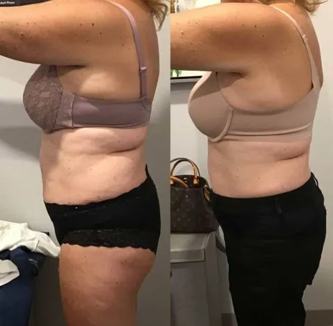 CryoSkin 19 Before & After Woman's body transformation, side view