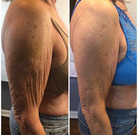 Before and After Pictures 73 Toning Treatment In Charlottesville, VA By Health & Wellness Spa