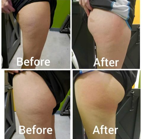 Before & After Image Of Toning Treatments In Charlottesville, VA By Health & Wellness Spa