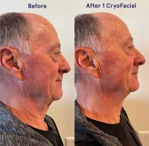 CryoSkin 37 Before and after Cryo Facial in Charlottesville