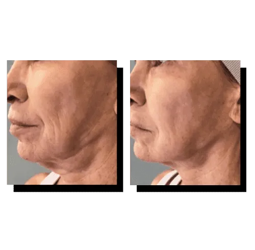 CryoSkin 33 Cryoskin Treatment Charlottesville, VA in Health & Wellness Spa