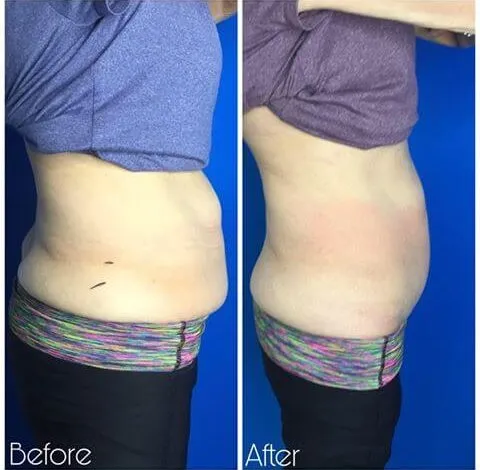 CryoSkin 12 Before and after slimming treatment results on abdomen in Charlottesville, VA