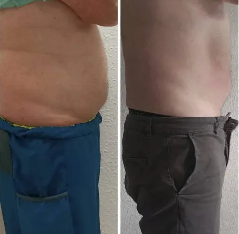 CryoSkin 13 Before and after slimmer waist treatment in Charlottesville, VA