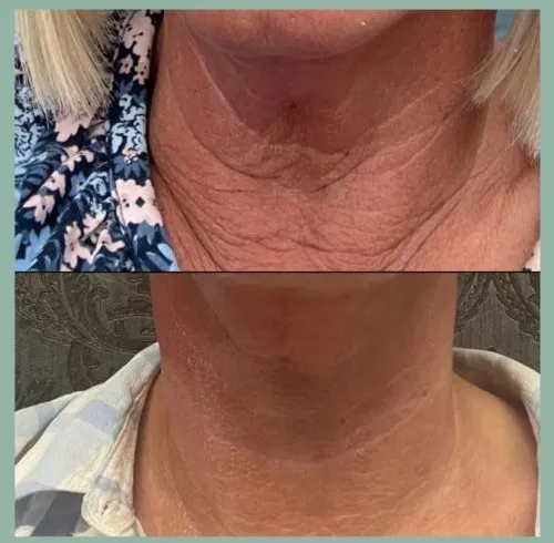 CryoSkin 40 Before and after neck treatment in Charlottesville