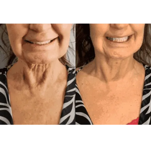 CryoSkin 36 CryoFacial Treatment in Charlottesville, VA by Health & Wellness Spa