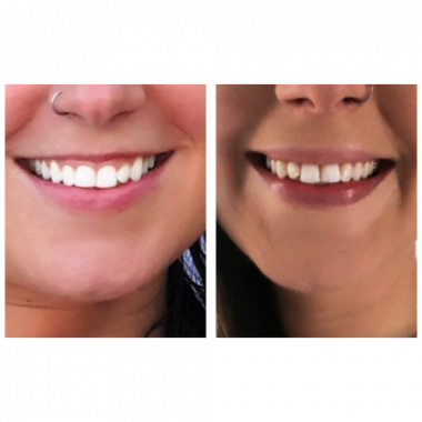 Teeth Whitning Treatment By Charlottesville, VA In Health & Wellness Spa