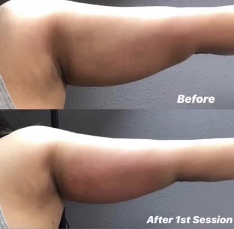 Before & After Image Of Slimming Treatment In Charlottesville, VA | Health & Wellness Spa