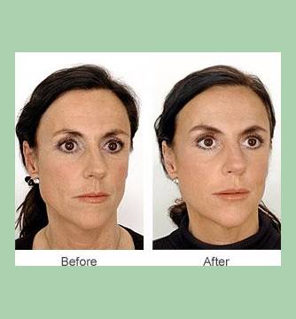 Before and After Images Of Fillers Treatment By Charlottesville, VA In Health & Wellness Spa