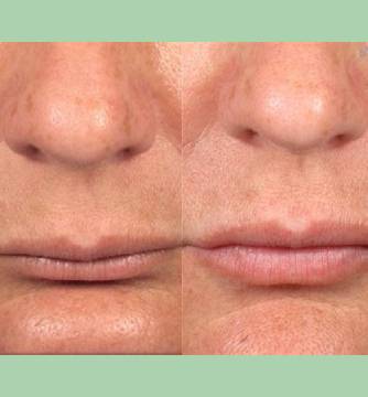 Dermal Filler 3 Lip Fillers By Charlottesville, VA In Health & Wellness Spa