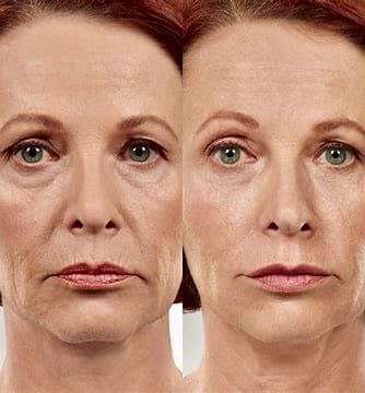 Dermal Filler 4 Before and After Images Of Beauty Treatment In Charlottesville, VA By Health & Wellness Spa