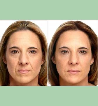 Dermal Filler 6 Before and After Images Of Nasolabial Fold Treatment By Charlottesville, VA In Health & Wellness Spa