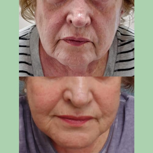 Before and After Images Of Anti-Wrinkle Treatment By Charlottesville, VA In Health & Wellness Spa