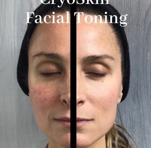Before & After Image Of Cryofacial In Charlottesville, VA By Health & Wellness Spa