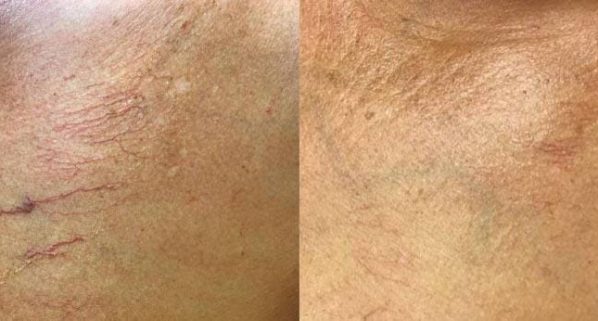 visible red and purple spider veins Charlottesville, VA