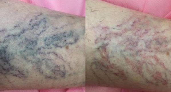 A dense area of dark blue and purple spider veins in Charlottesville, VA, by Health and Wellness Spa