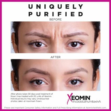 Before & After Xeomin Treatment In Charlottesville, VA By Health and Wellness Spa