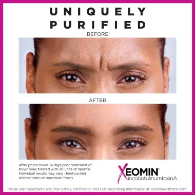 Before & After Xeomin Treatment In Charlottesville, VA By Health & Wellness Spa