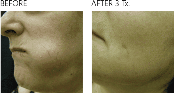 woman's jawline and lower cheek, Charlottesville, VA by Health & Wellness Spa