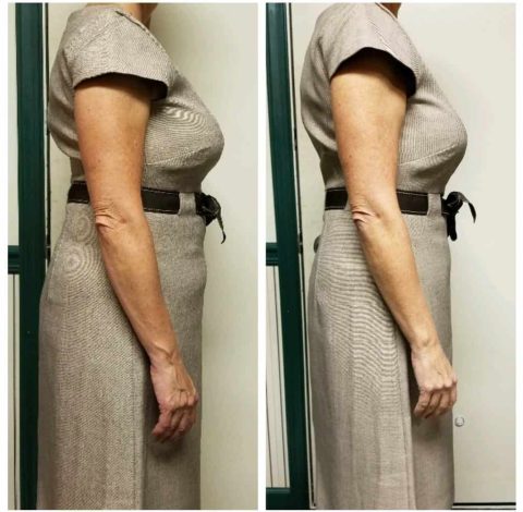 Before And After Slimming Treatment Charlottesville, VA by Health and Wellness Spa