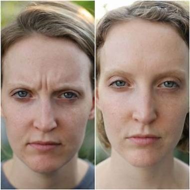 Before & After Botox Treatment In Charlottesville, VA By Health and Wellness Spa