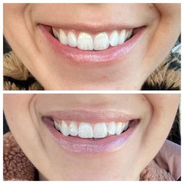 Before and After Lip Flip Treatment In Charlottesville, VA By Health & Wellness Spa