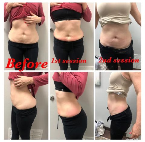 Before & After Image Of Cryo Slimming Treatment In Charlottesville, VA By Health & Wellness Spa