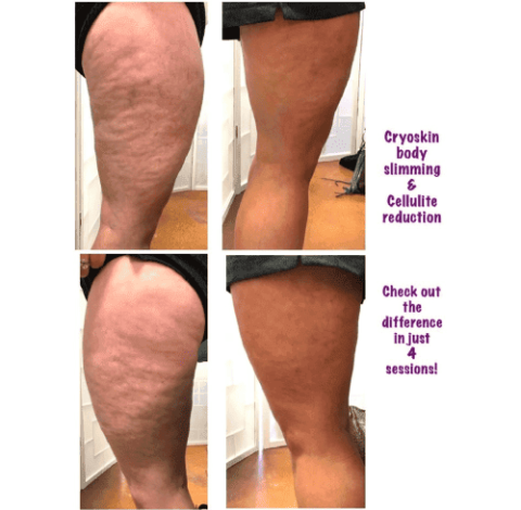 Cellulite Treatment Charlottesville, VA in Health & Wellness Spa