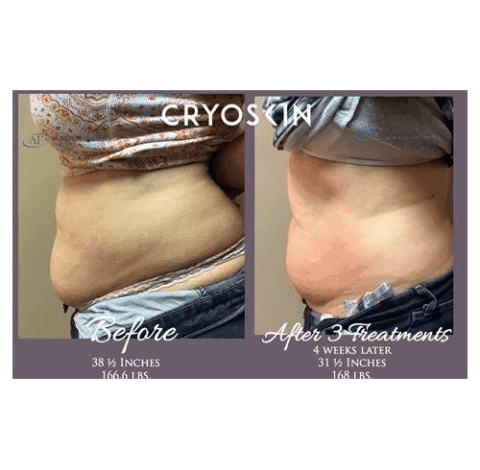 Slimming Treatment Charlottesville, VA in Health & Wellness Spa