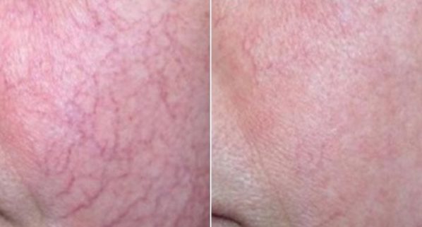 Prominent red spider veins in Charlottesville, VA by Health and Wellness Spa
