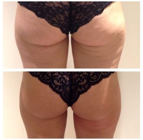 Before and After Pictures 75 Before & After Image Of Toning In Charlottesville, VA By Health & Wellness Spa