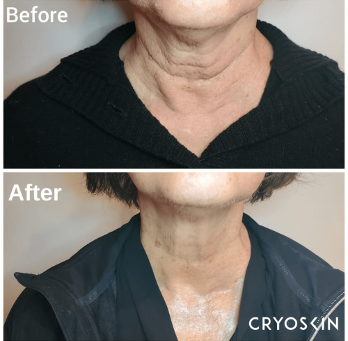 Before & After Image Of CryoFacial Treatment In Charlottesville, VA | Health & Wellness Spa